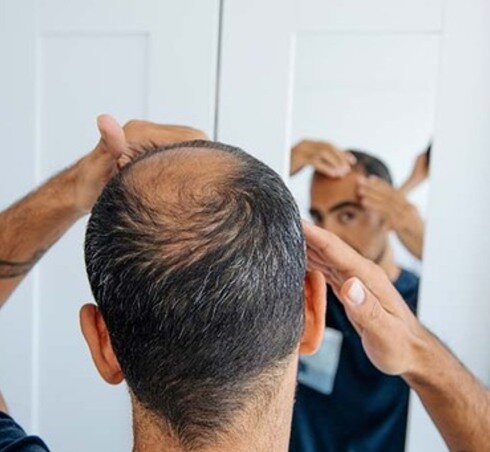 hair loss thumbnail