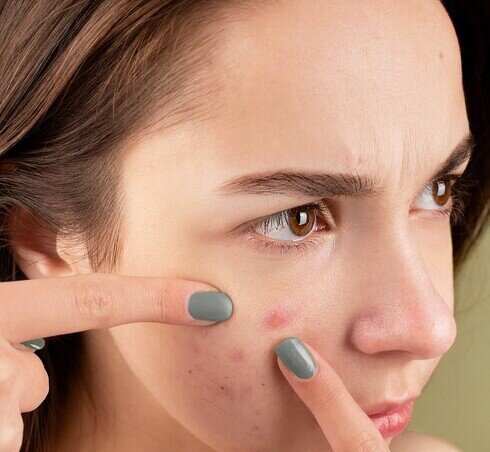acne thumbnail